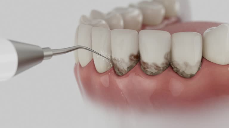 Trusted Wisdom Tooth Removal service in Erie, CO - Dentist Open Now